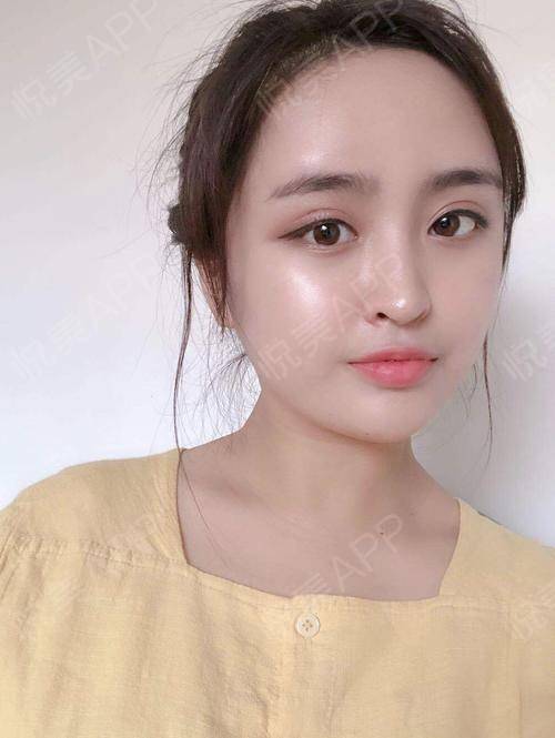 苹果肌填充(苹果肌填充用什么材料好)